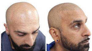 What Is Scalp Micropigmentation