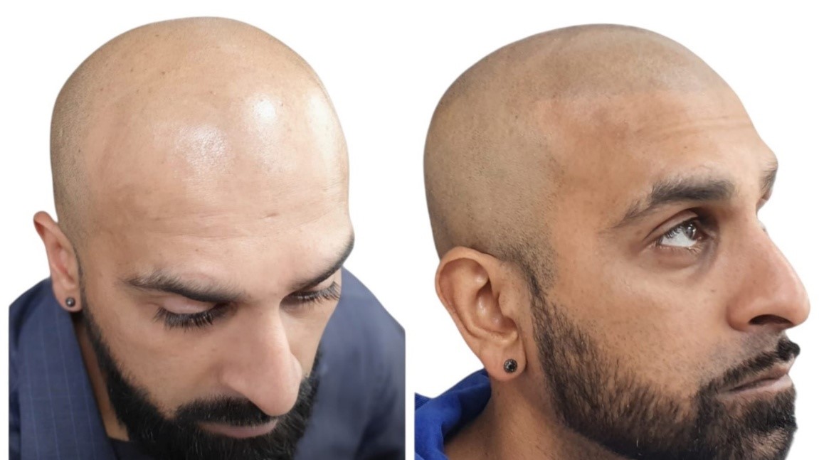 What Is Scalp Micropigmentation