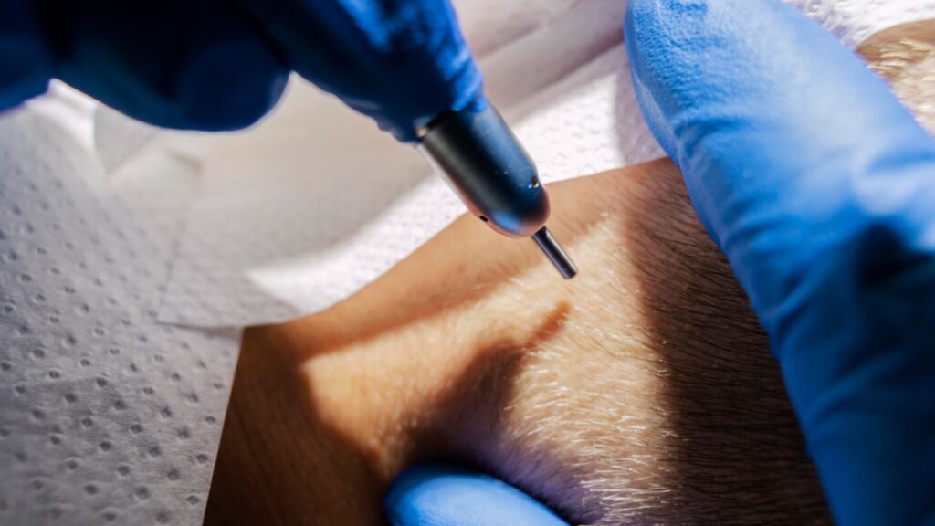 Difference Between Scalp Micropigmentation and Microblading