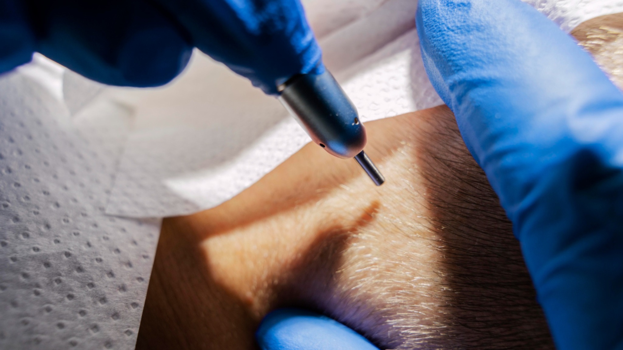 Difference Between Scalp Micropigmentation and Microblading