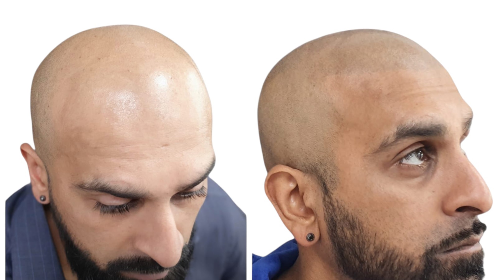 scalp micropigmentation Milton Keynes