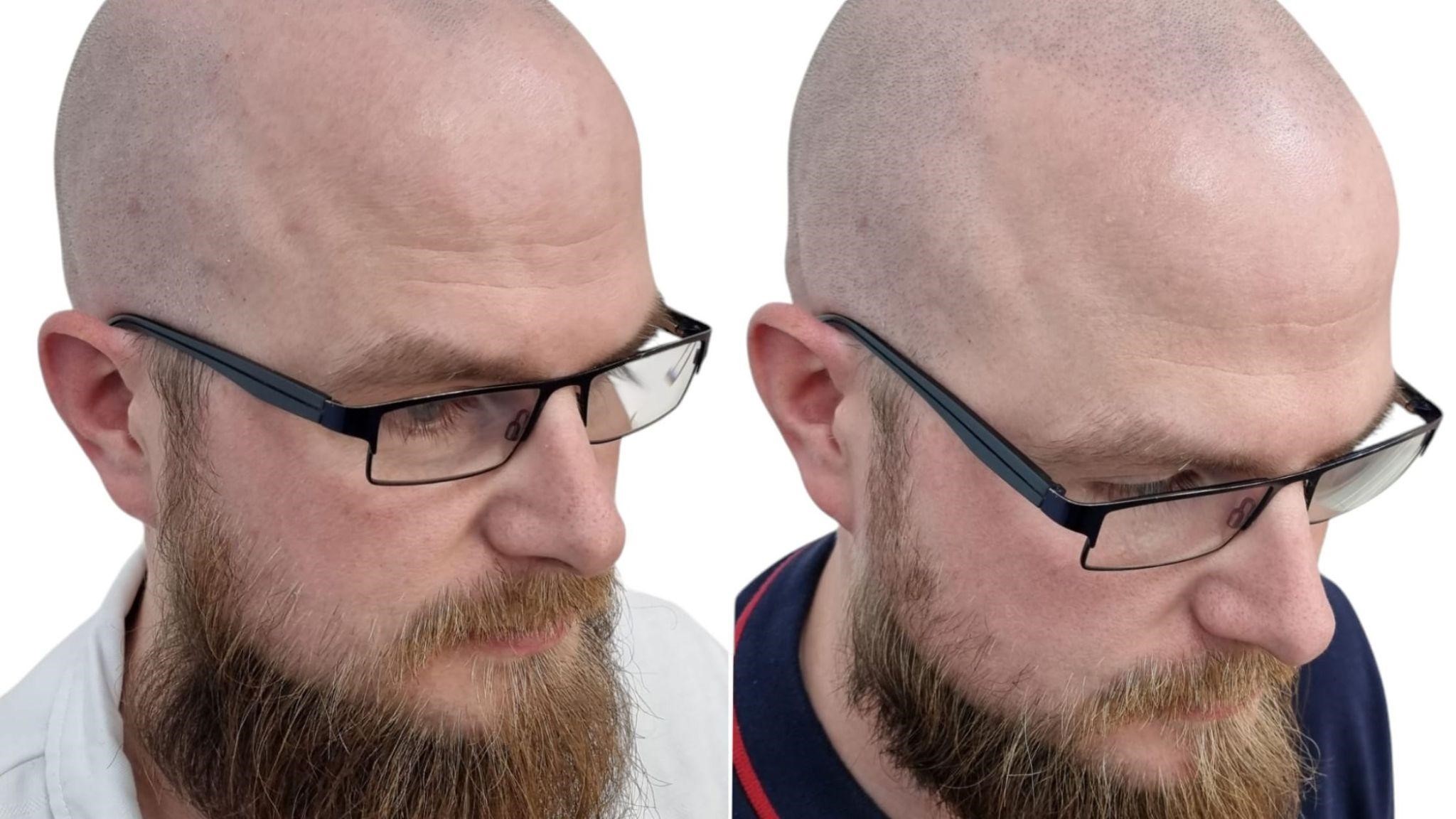 scalp micropigmentation