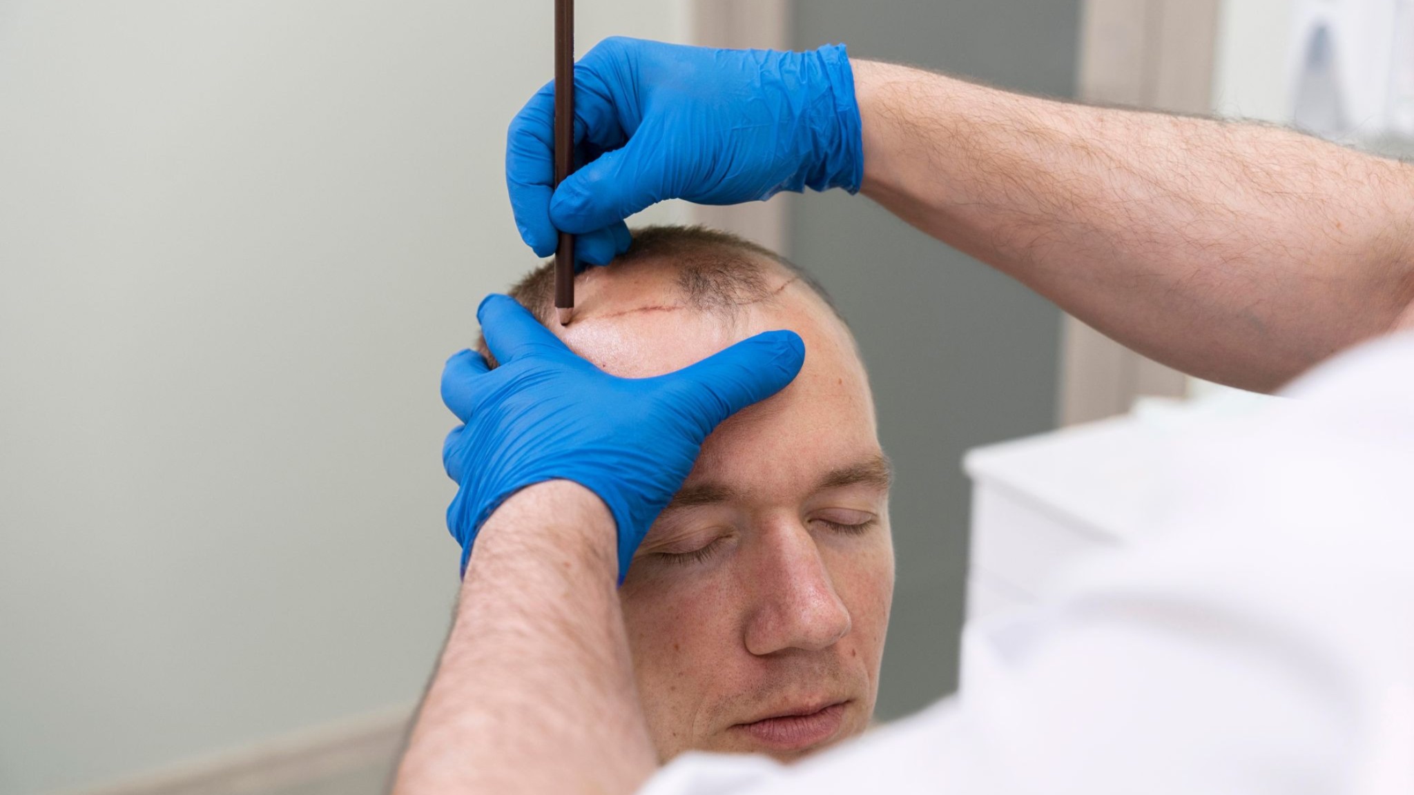 Hair Tattoo Cost Vs Hair Transplant Cost
