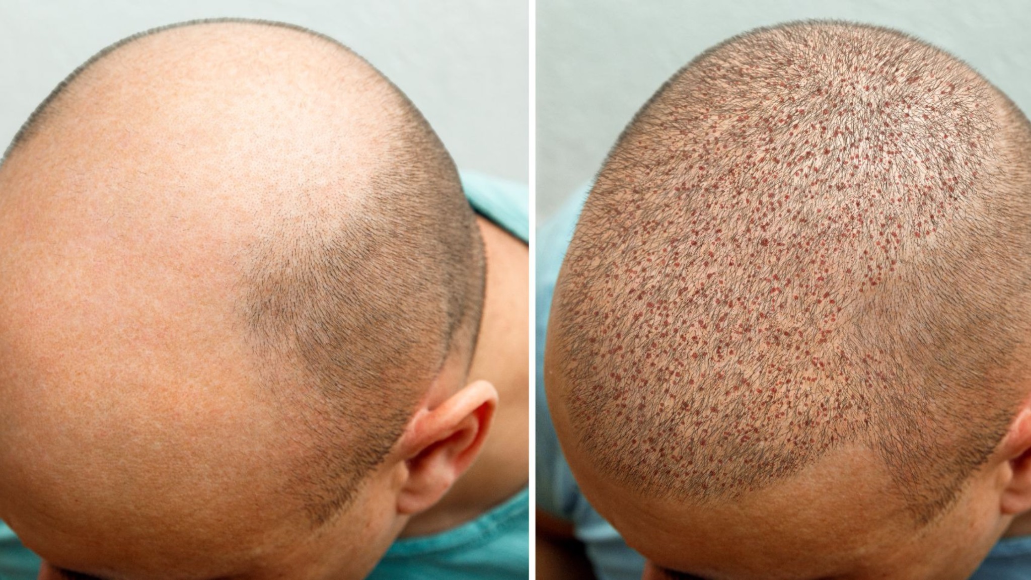 Hair Transplant Cost