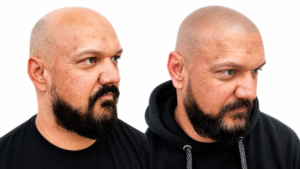 Scalp Micropigmentation Before and After