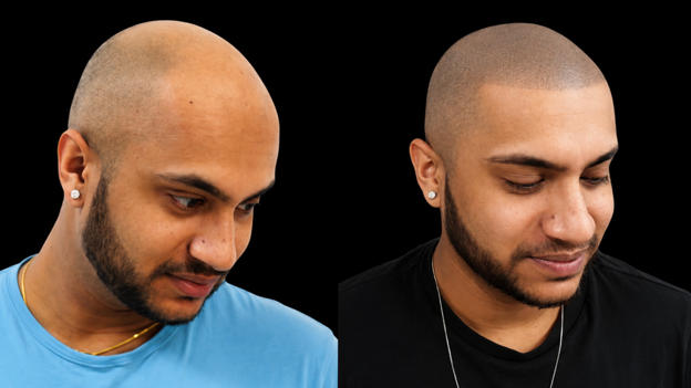 Head Tattoos for Hair Loss